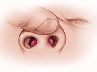 Burunda Kemik Erimesi Belirtileri ve Tedavisi