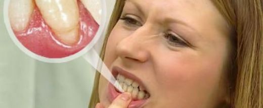 Diş Eti Kemik Erimesi Belirtileri ve Tedavisi